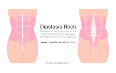 Belly Gap (Diastasis recti)